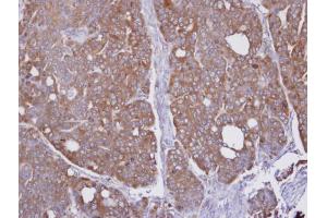 IHC-P Image Immunohistochemical analysis of paraffin-embedded NCI-N87 xenograft, using HAGH, antibody at 1:100 dilution.