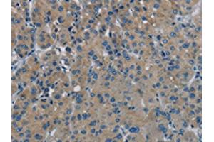 The image on the left is immunohistochemistry of paraffin-embedded Human liver cancer tissue using ABIN7191867(PHKG1 Antibody) at dilution 1/20, on the right is treated with synthetic peptide. (PHKG1 anticorps)