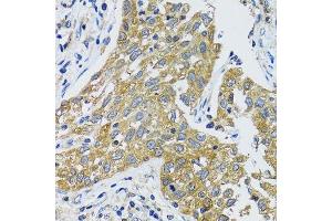 Immunohistochemistry of paraffin-embedded human lung cancer using GOT1 antibody.