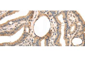 Immunohistochemistry of paraffin-embedded Human thyroid cancer tissue using TRIB3 Polyclonal Antibody at dilution 1:40 (TRIB3 anticorps)