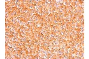 IHC-P Image AIMP1 antibody detects SCYE1 protein at cytosol on H1299 xenograft by immunohistochemical analysis.