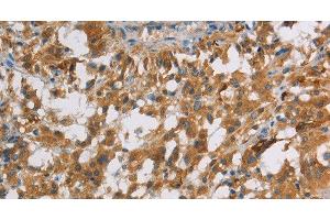 Immunohistochemistry of paraffin-embedded Human thyroid cancer using DBH Polyclonal Antibody at dilution of 1:70