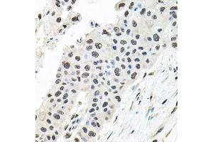 Immunohistochemistry of paraffin-embedded human lung cancer using CDC antibody (ABIN6127612, ABIN6138273, ABIN6138274 and ABIN6216282) at dilution of 1:100 (40x lens).