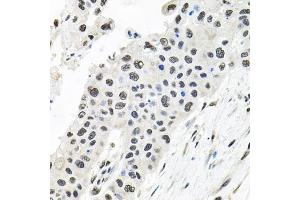 Immunohistochemistry of paraffin-embedded human lung cancer using CDC antibody (ABIN6127612, ABIN6138273, ABIN6138274 and ABIN6216282) at dilution of 1:100 (40x lens). (CDCA8 anticorps  (AA 1-280))
