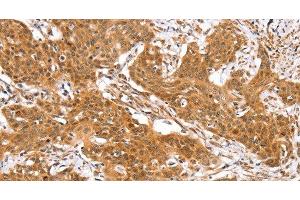 Immunohistochemistry of paraffin-embedded Human cervical cancer using RGS22 Polyclonal Antibody at dilution of 1:40 (RGS22 anticorps)