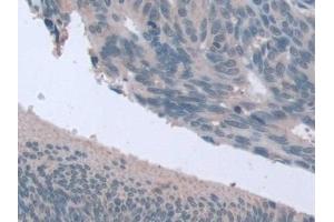 Detection of STIP1 in Human Colorectal cancer Tissue using Polyclonal Antibody to Stress Induced Phosphoprotein 1 (STIP1)