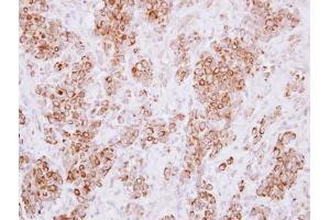 IHC-P Image Immunohistochemical analysis of paraffin-embedded human breast cancer, using HLA-DMA, antibody at 1:250 dilution. (HLA-DMA anticorps)
