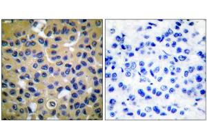Immunohistochemical analysis of paraffin-embedded human breast carcinoma tissue, using COL2 antibody (ABIN5976364).