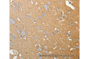 Immunohistochemistry of Human colon cancer using SLC4A4 Polyclonal Antibody at dilution of 1:50 (SLC4A4 anticorps)