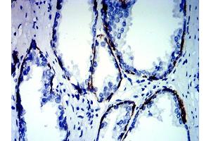 Immunohistochemical analysis of paraffin-embedded prostate cancer tissues using KRT13 mouse mAb with DAB staining. (Cytokeratin 13 anticorps  (AA 104-458))