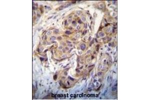 DUSP3 Antibody (C-term) (ABIN392859 and ABIN2842277) immunohistochemistry analysis in formalin fixed and paraffin embedded human breast carcinoma followed by peroxidase conjugation of the secondary antibody and DAB staining.