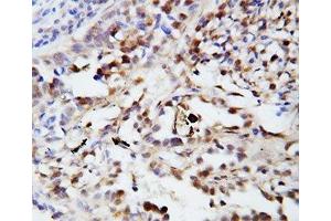 IHC-P: Ubiquitin antibody testing of human lung cancer tissue
