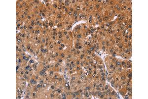 Immunohistochemistry of Human liver cancer using ING2 Polyclonal Antibody at dilution of 1:40 (ING2 anticorps)