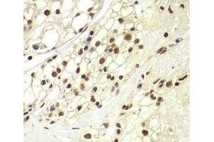 Immunohistochemistry of paraffin-embedded Human kidney cancer using RPA2 Polyclonal Antibody at dilution of 1:100 (40x lens). (RPA2 anticorps)