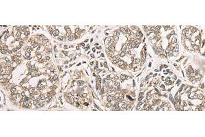 Immunohistochemistry of paraffin-embedded Human esophagus cancer tissue using COA7 Polyclonal Antibody at dilution of 1:55(x200) (C1orf163 anticorps)