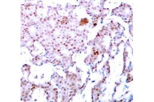 Immunohistochemistry of paraffin-embedded human breast carcinoma using Phospho-RELA-S536 antibody (ABIN2987368). (NF-kB p65 anticorps  (pSer536))