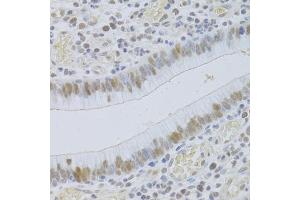 Immunohistochemistry of paraffin-embedded human gastric cancer using JMJD6 Antibody (ABIN5973452) at dilution of 1/100 (40x lens). (JMJD6 anticorps)