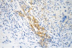 Immunohistochemistry was performed on paraffin-embedded human breast carcinoma using STAT5A antibody (ABIN7800347), 1:200). (Recombinant STAT5A anticorps)