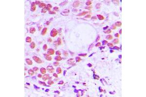 Immunohistochemical analysis of TIF1 alpha staining in human breast cancer formalin fixed paraffin embedded tissue section.