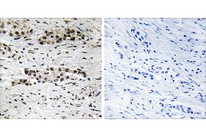 P-peptide - +Immunohistochemistry analysis of paraffin-embedded human breast carcinoma tissue using Estrogen Receptor-α (Phospho-Ser102) antibody.