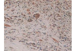 Detection of EZH2 in Human Prostate Gland Cancer Tissue using Polyclonal Antibody to Enhancer Of Zeste Homolog 2 (EZH2)