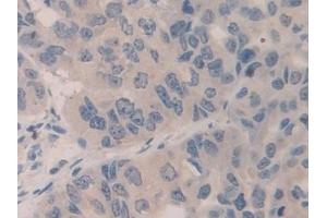 Detection of SMC3 in Human Breast cancer Tissue using Polyclonal Antibody to Structural Maintenance Of Chromosomes Protein 3 (SMC3)