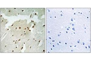 Immunohistochemistry analysis of paraffin-embedded human lung carcinoma, using Ku70 (Phospho-Ser5) Antibody.