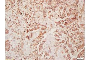 Formalin-fixed and paraffin embedded human lung carcinoma labeled with Anti-DISP2 Polyclonal Antibody, Unconjugated (ABIN1386087) at 1:200 followed by conjugation to the secondary antibody and DAB staining (DISP2 anticorps  (AA 1101-1200))