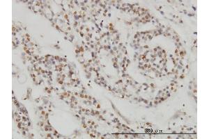 Immunoperoxidase of monoclonal antibody to DPF2 on formalin-fixed paraffin-embedded human ovary, clear cell carcinoma. (DPF2 anticorps  (AA 56-155))