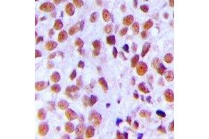 Immunohistochemical analysis of Ku80 (pT714) staining in human breast cancer formalin fixed paraffin embedded tissue section.