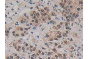 Detection of HSPA1A in Human Prostate cancer Tissue using Polyclonal Antibody to Heat Shock 70 kDa Protein 1A (HSPA1A)