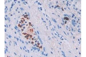 Detection of IL6 in Human Lung cancer Tissue using Monoclonal Antibody to Interleukin 6 (IL6)