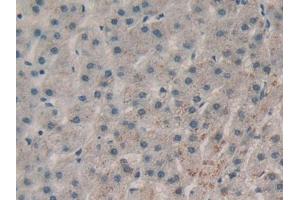 DAB staining on IHC-P; Samples: Human Liver cancer Tissue