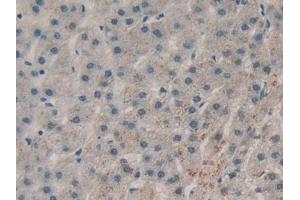 DAB staining on IHC-P; Samples: Human Liver cancer Tissue (RNASE1 anticorps  (AA 29-156))