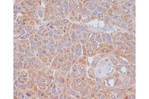 Immunohistochemical analysis of paraffin-embedded human lung cancer, using ATG9A Antibody. (Recombinant ATG9A anticorps)