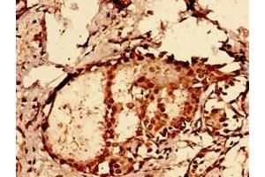 Immunocytochemistry analysis of human breast cancer using ABIN7162002 at dilution of 1:100