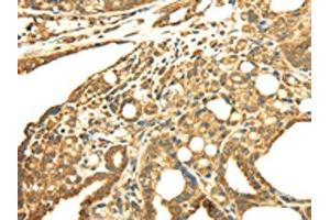 The image on the left is immunohistochemistry of paraffin-embedded Human thyroid cancer tissue using ABIN7128021(SRPRB Antibody) at dilution 1/30, on the right is treated with fusion protein. (SRPRB anticorps)