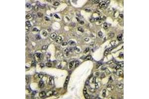 IHC analysis of FFPE human breast carcinoma stained with AKT1 antibody