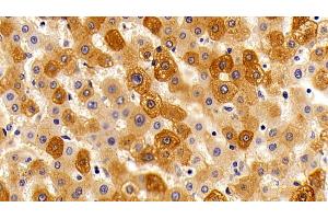 Detection of ORM2 in Human liver Cirrhosis Tissue using Polyclonal Antibody to Orosomucoid 2 (ORM2) (Orosomucoid 2 anticorps)