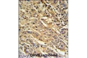 F91A1 Antibody (N-term) (ABIN651217 and ABIN2840136) IHC analysis in formalin fixed and paraffin embedded human cervix carcinoma followed by peroxidase conjugation of the secondary antibody and DAB staining. (FAM91A1 anticorps  (N-Term))