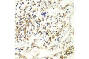 Immunohistochemistry of paraffin-embedded human liver cancer using UPF1 antibody. (RENT1/UPF1 anticorps  (AA 270-370))