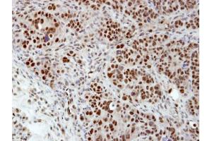 IHC-P Image Immunohistochemical analysis of paraffin-embedded NCIN87 xenograft, using hnRNP H, antibody at 1:100 dilution. (HNRNPH1 anticorps)