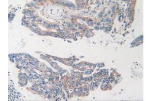 IHC-P analysis of Human Rectum Cancer Tissue, with DAB staining. (MVP anticorps  (AA 2-272))