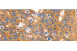 Immunohistochemistry of paraffin-embedded Human ovarian cancer tissue using MYOD1 Polyclonal Antibody at dilution of 1:120(x200) (MYOD1 anticorps)
