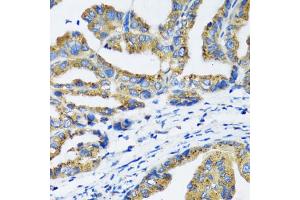 Immunohistochemistry of paraffin-embedded human gastric cancer using NFKB1 antibody (ABIN6292205) at dilution of 1:100 (40x lens). (NFKB1 anticorps)
