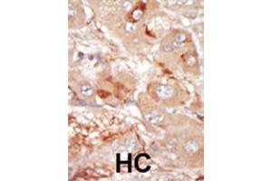 Formalin-fixed and paraffin-embedded human cancer tissue reacted with the primary antibody, which was peroxidase-conjugated to the secondary antibody, followed by DAB staining.