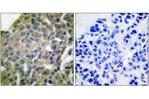 Immunohistochemistry analysis of paraffin-embedded human breast carcinoma tissue, using GRP94 Antibody. (GRP94 anticorps  (AA 754-803))