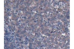 Detection of CSF2Rb in Human Endometrial cancer Tissue using Polyclonal Antibody to Colony Stimulating Factor 2 Receptor Beta (CSF2Rb)