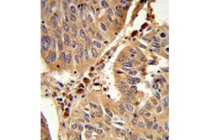 Formalin-fixed and paraffin-embedded human lung carcinoma reacted with Peroxin 16 / PEX16 Antibody (Center) followed which was peroxidase-conjugated to the secondary antibody, followed by DAB staining. (PEX16 anticorps  (Middle Region))