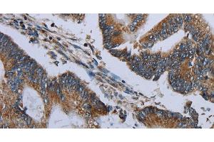 Immunohistochemistry of paraffin-embedded Human colon cancer using NDUFA13 Polyclonal Antibody at dilution of 1:50